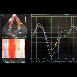 スペックルトラッキング法