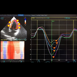 スペックルトラッキング法