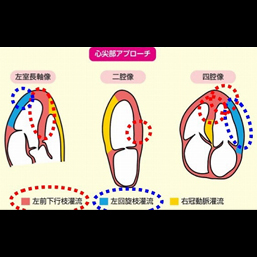 スペックルトラッキング法