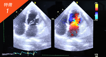 当院だけの特徴スペックルトラッキング